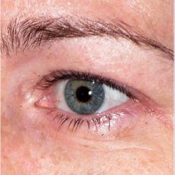 Thermage Before & After Patient #1591